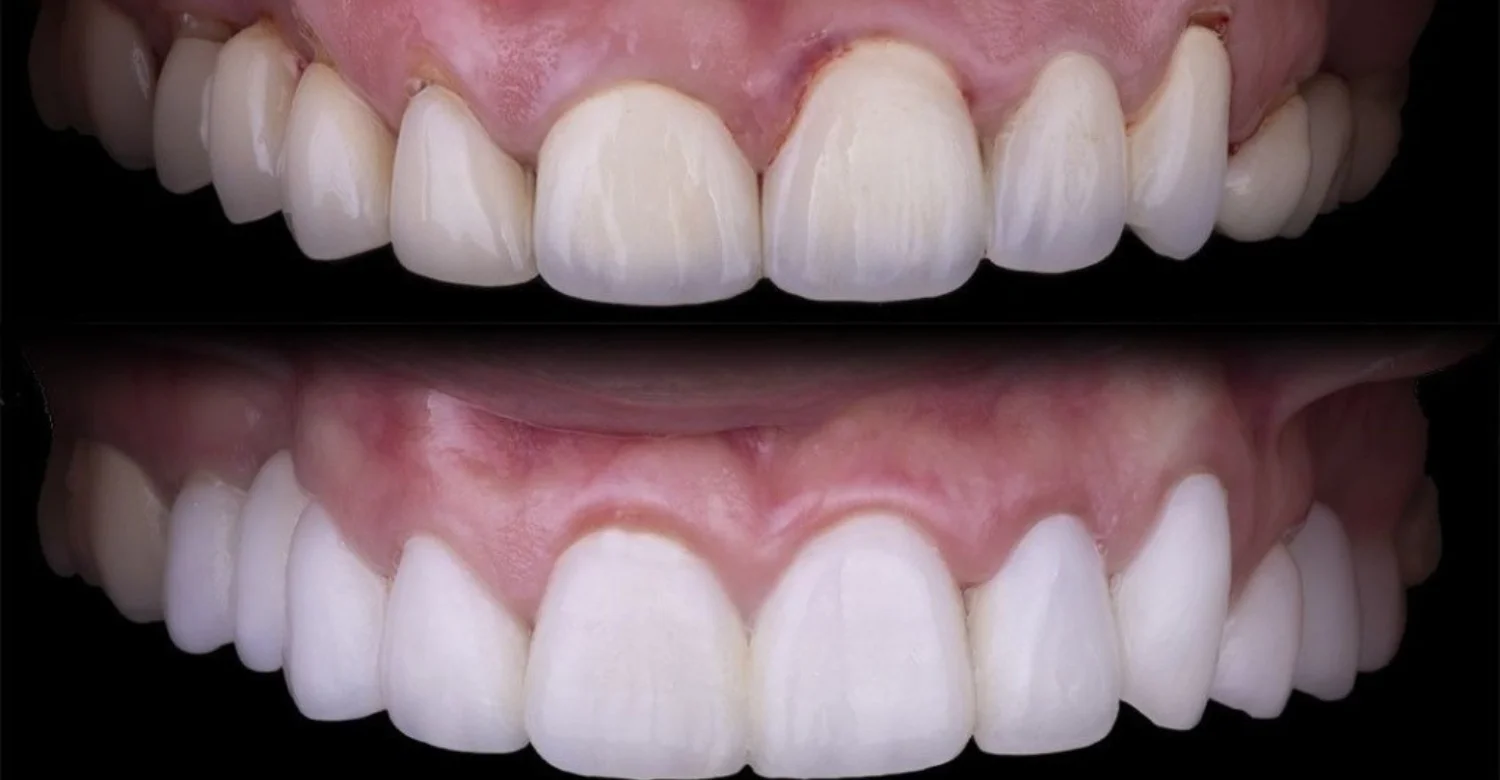 Crown Lengthening Surgery1